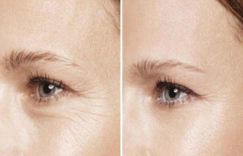 Dipeptide Diaminobutyroyl Non-Invasive Wrinkle Reduction | Shaanxi BLOOM Tech Co., Ltd Dipeptide Diaminobutyroyl Non-Invasive Wrinkle Reduction | Shaanxi BLOOM Tech Co., Ltd